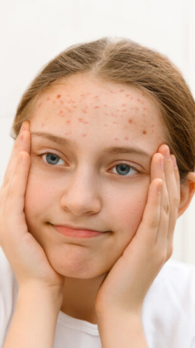 Acne Treatment in Kochi for managing childhood acne